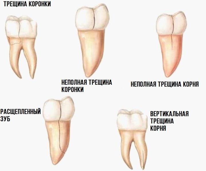 К чему снятся гнилые зубы: толкование по различным сонникам